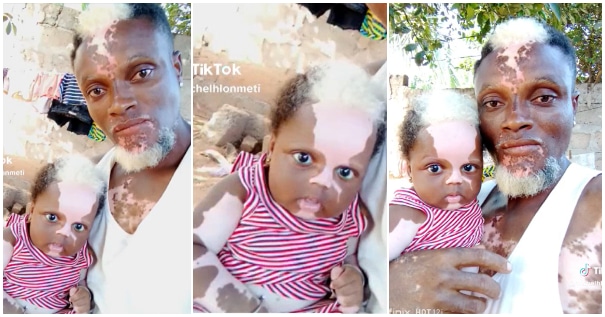 Man and daughter with vitiligo |Battabox.com
