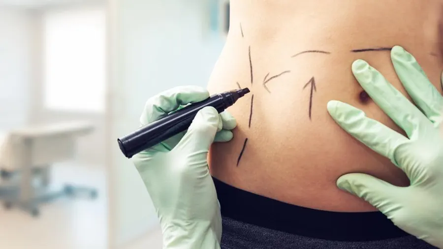 Different Methods of Liposuction