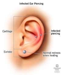 Ear Piercing Infections