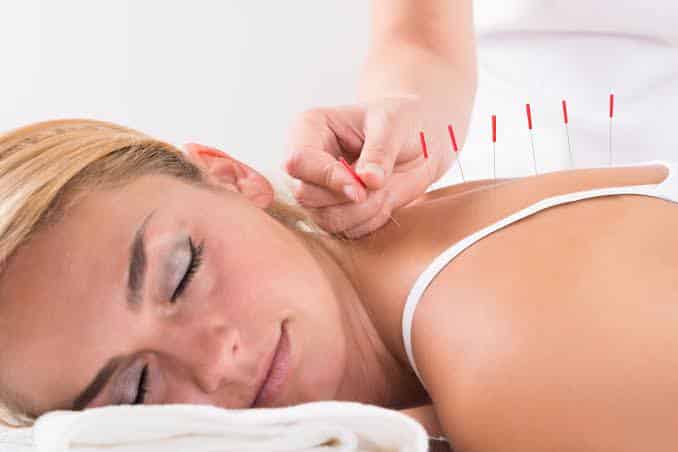What to expect during Acupuncture