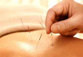 How Long Does Acupuncture Last?
