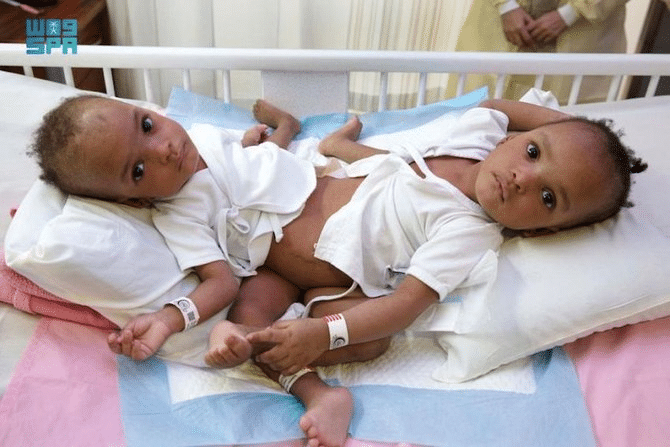 Nigerian conjoined twins