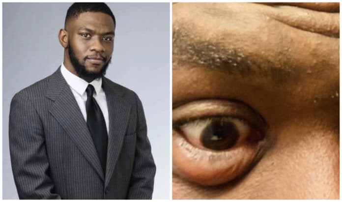 man shares condition of his eyes after studying for 13 hours daily